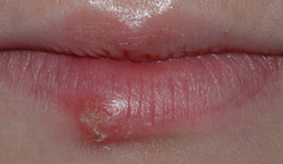 Herpes_munnsar_w300__114820c0237ed1e590af96c5dea21e15