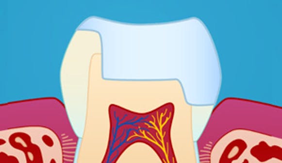 Porselensinnlegg-_w300__3f63457d86dbc43396fbb046f07ae8b1